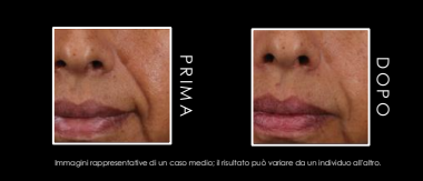Risultati prima e dopo l'applicazione del siero HA Intensifier di SkinCeuticals